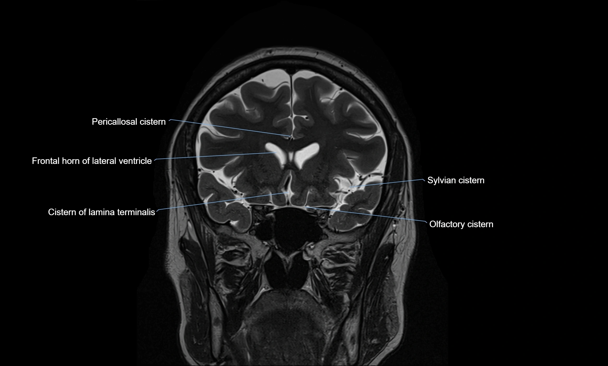 Brain cisterns  and ventricles coronal anatomy 3T MRI image-img-00001-00017.webp